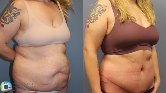 Before & After Body Lift Case 11948 Right Oblique in Denver and Colorado Springs, CO