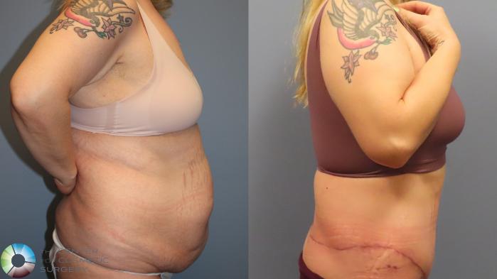 Before & After Tummy Tuck Case 11948 Right Side in Denver and Colorado Springs, CO