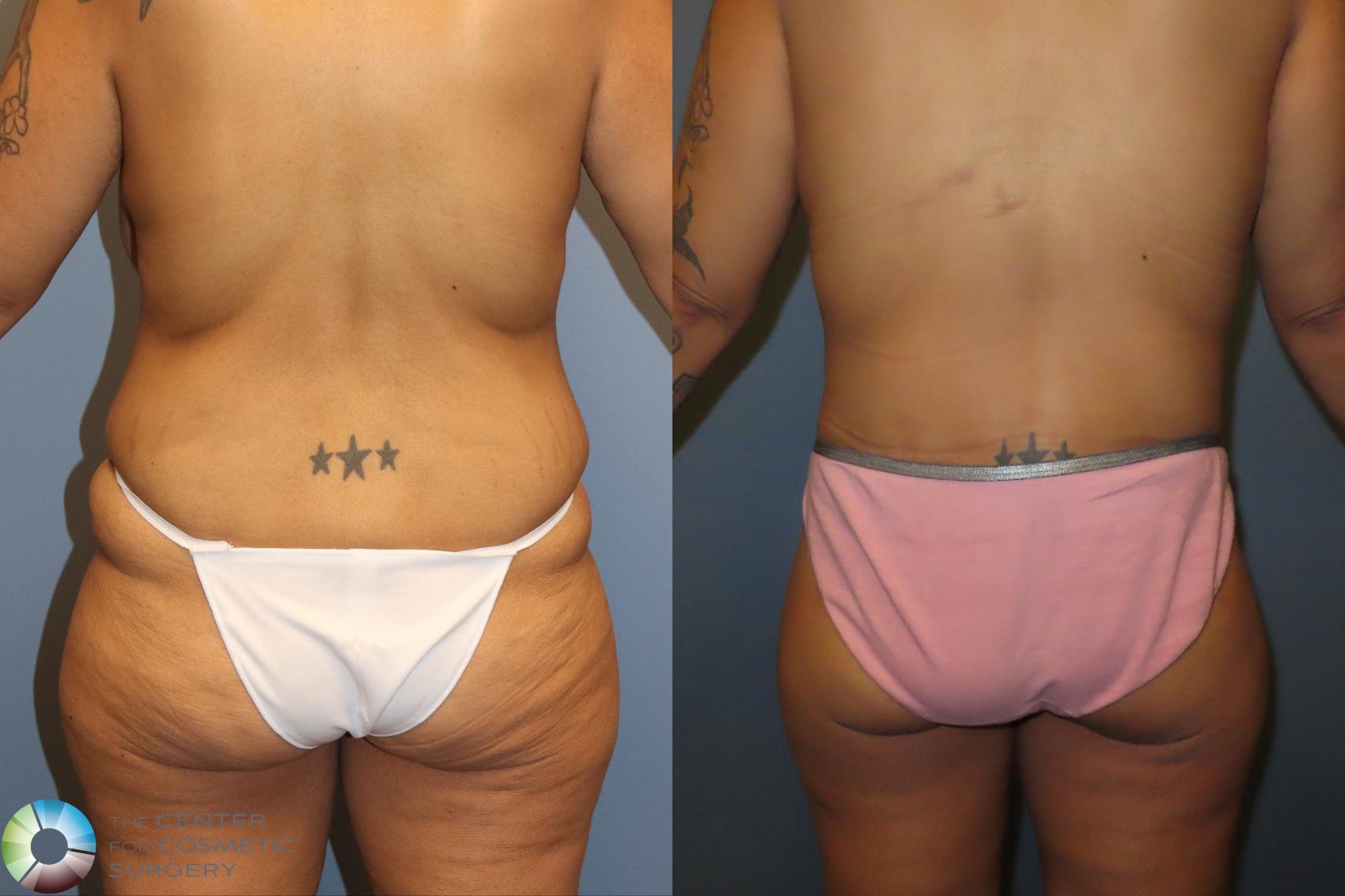 Before & After Body Lift Case 12133 Back in Denver and Colorado Springs, CO
