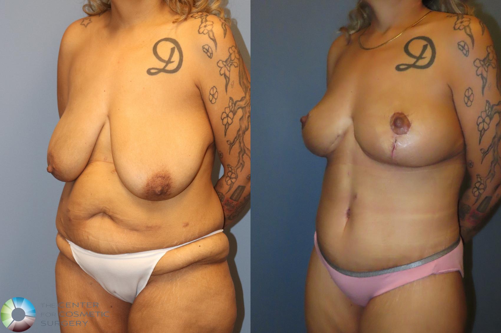 Before & After Body Lift Case 12133 Left Oblique in Denver and Colorado Springs, CO