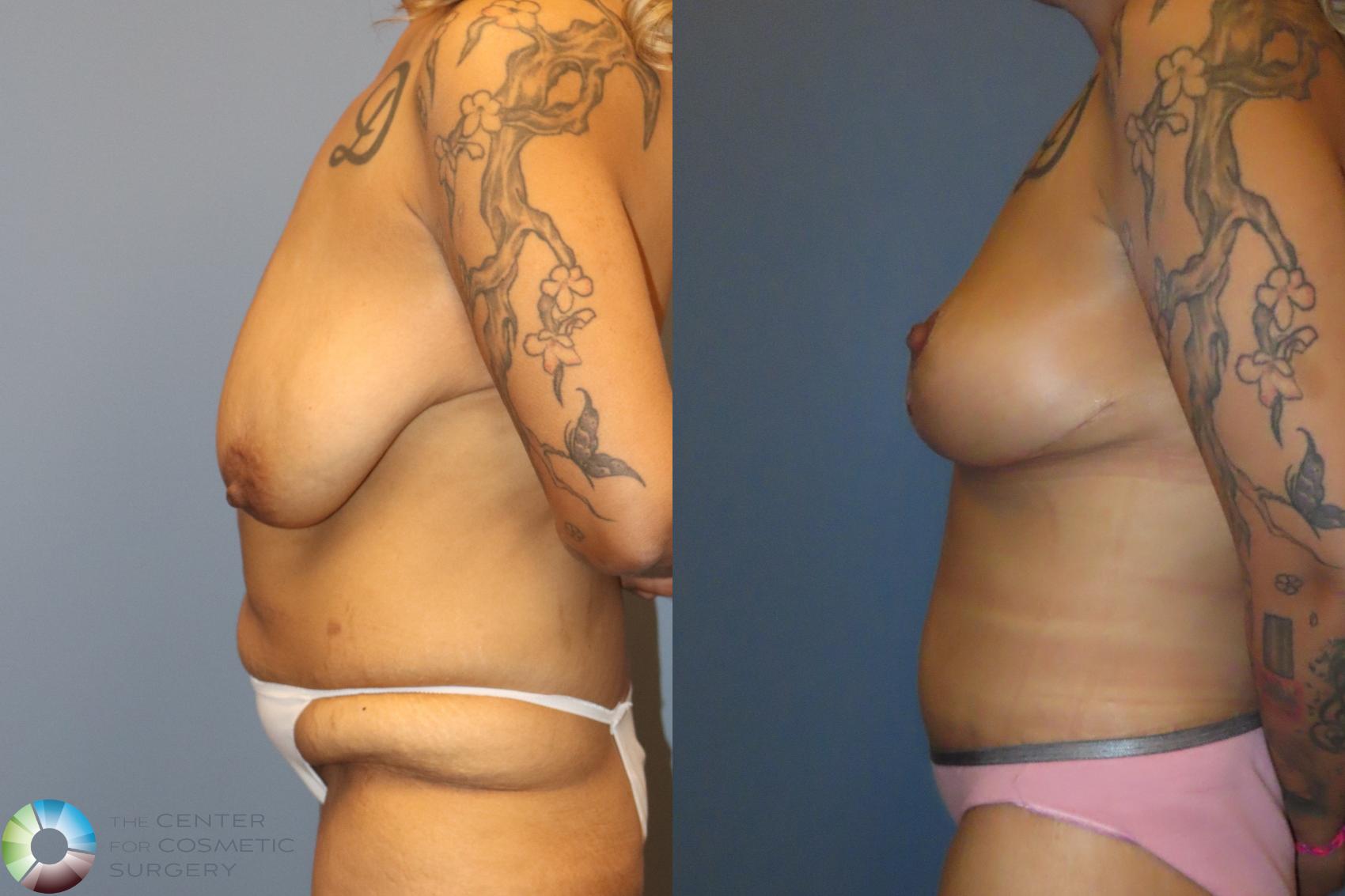 Before & After Body Lift Case 12133 Left Side in Denver and Colorado Springs, CO
