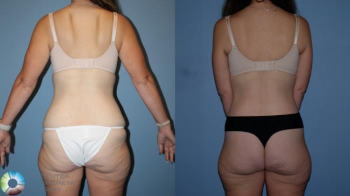 Before & After Body Lift Case 12189 Back in Denver and Colorado Springs, CO