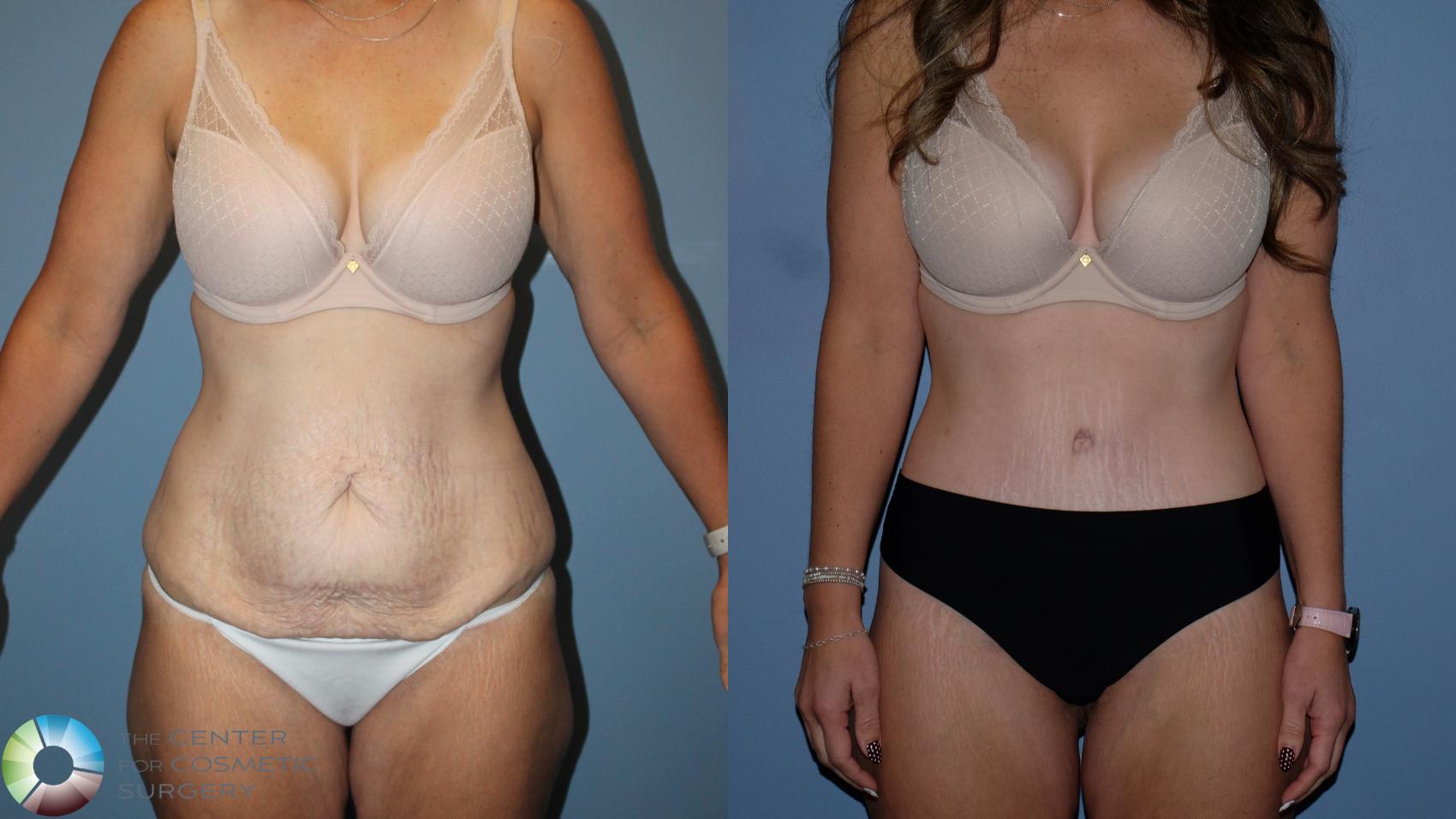 Before & After Body Lift Case 12189 Front in Denver and Colorado Springs, CO