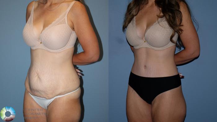 Before & After Body Lift Case 12189 Left Oblique in Denver and Colorado Springs, CO