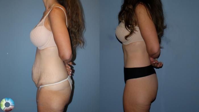 Before & After Body Lift Case 12189 Left Side in Denver and Colorado Springs, CO