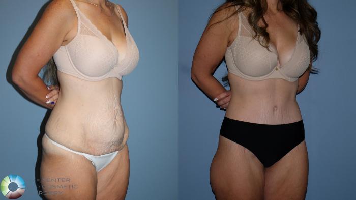 Before & After Body Lift Case 12189 Right Oblique in Denver and Colorado Springs, CO