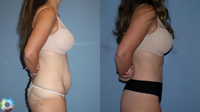 Before & After Body Lift Case 12189 Right Side in Denver and Colorado Springs, CO
