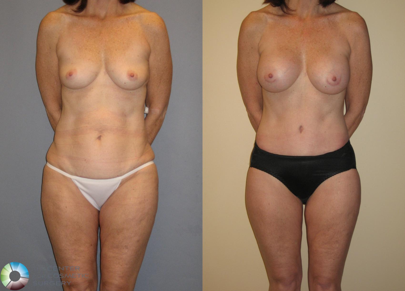 Before & After Thigh Lift Case 125 View #1 View in Denver & Golden, CO