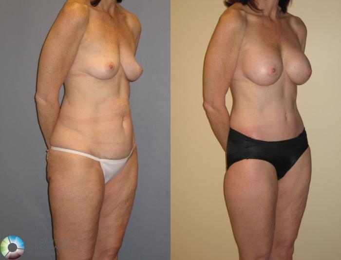 Before & After Thigh Lift Case 125 View #2 View in Golden, CO