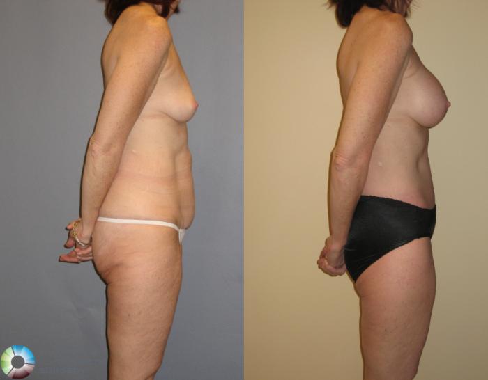 Before & After Thigh Lift Case 125 View #3 View in Golden, CO