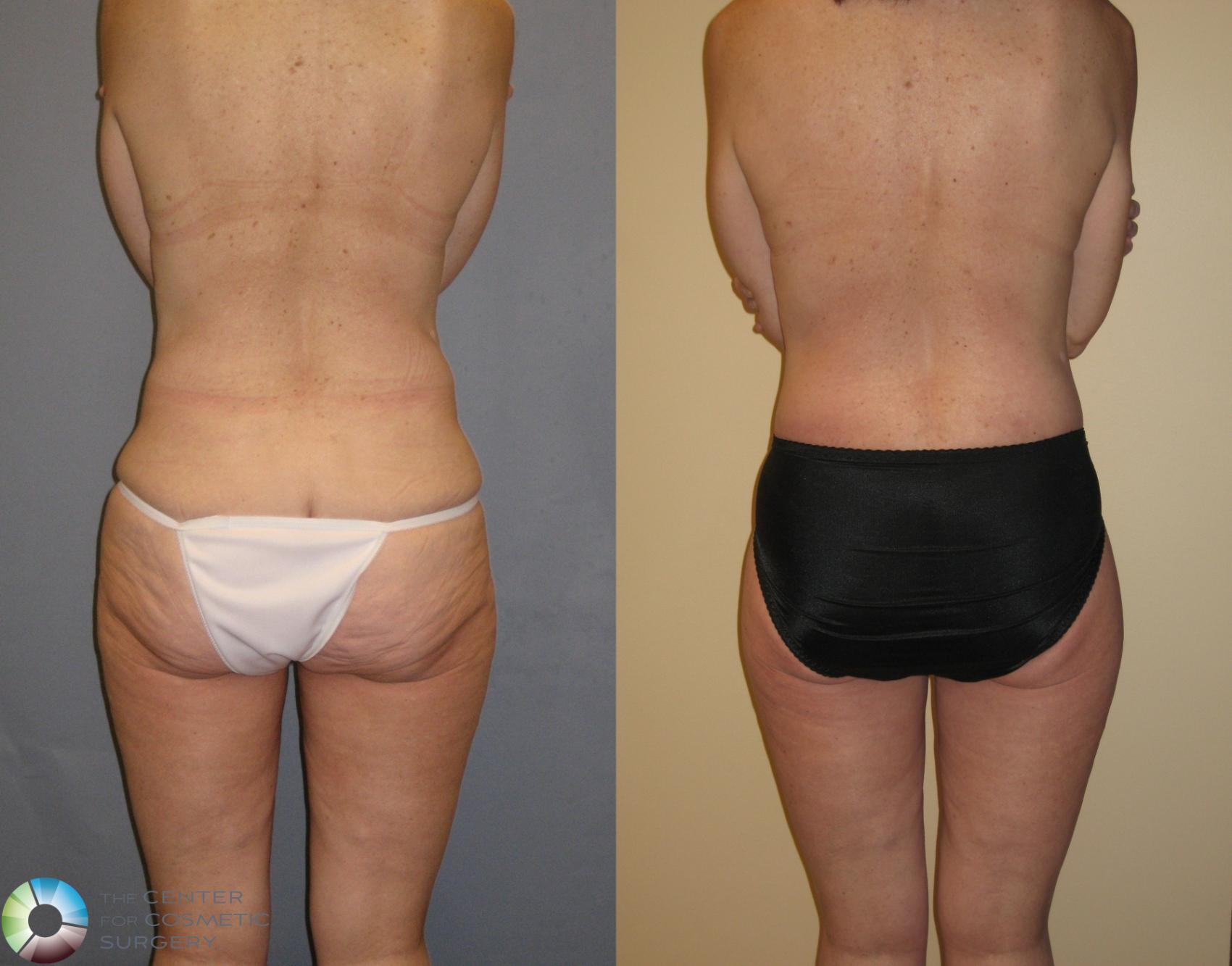 Before & After Body Lift Case 125 View #4 View in Denver & Golden, CO