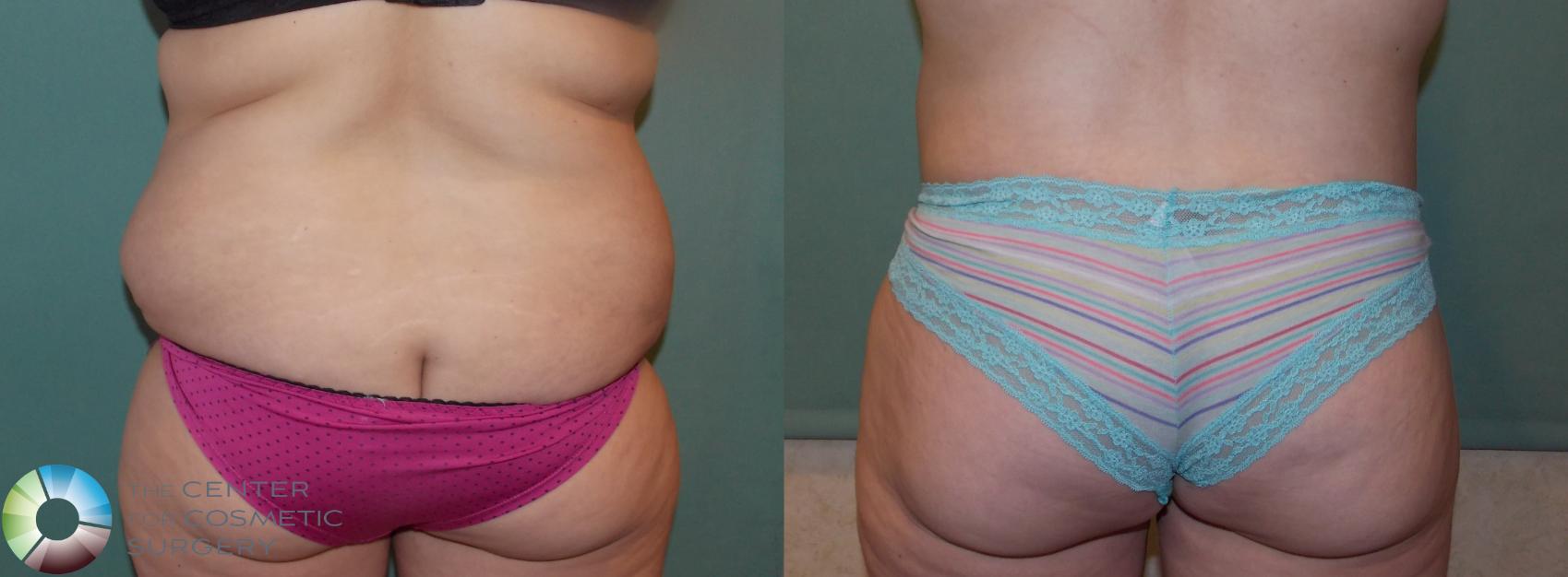 Before & After Buttock Lift Case 740 View #1 in Denver and Colorado Springs, CO