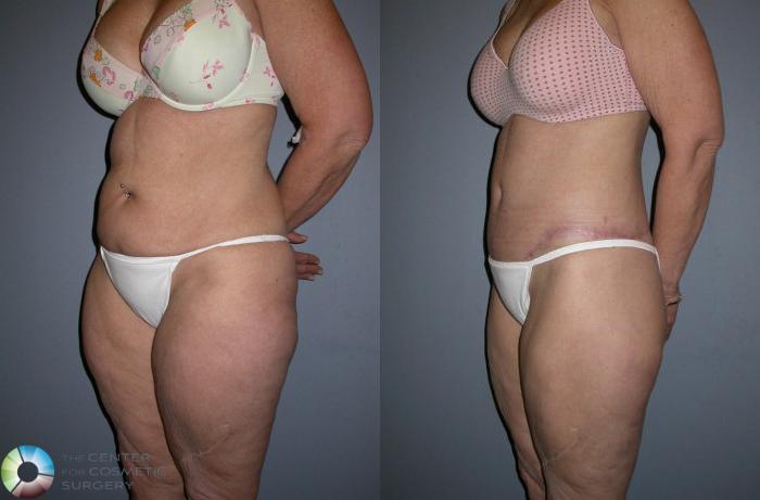 Before & After Thigh Lift Case 76 View #2 View in Golden, CO