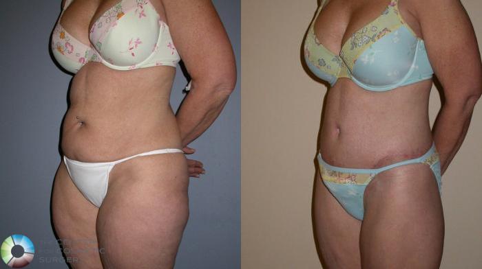 Before & After Thigh Lift Case 76 View #3 View in Golden, CO
