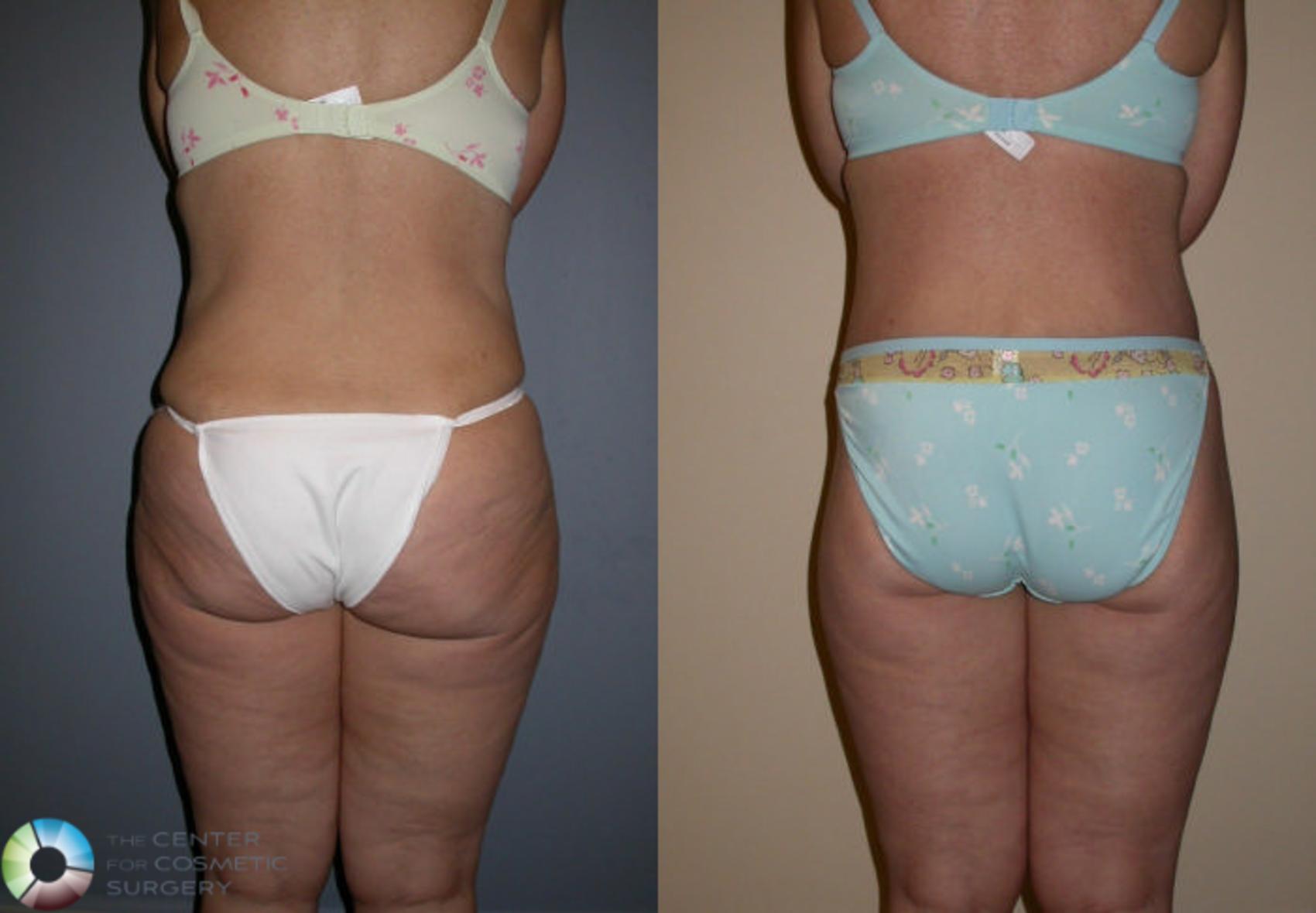 Before & After Body Lift Case 76 View #4 View in Golden, CO