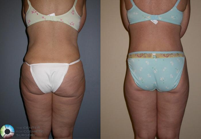 Before & After Thigh Lift Case 76 View #4 View in Golden, CO