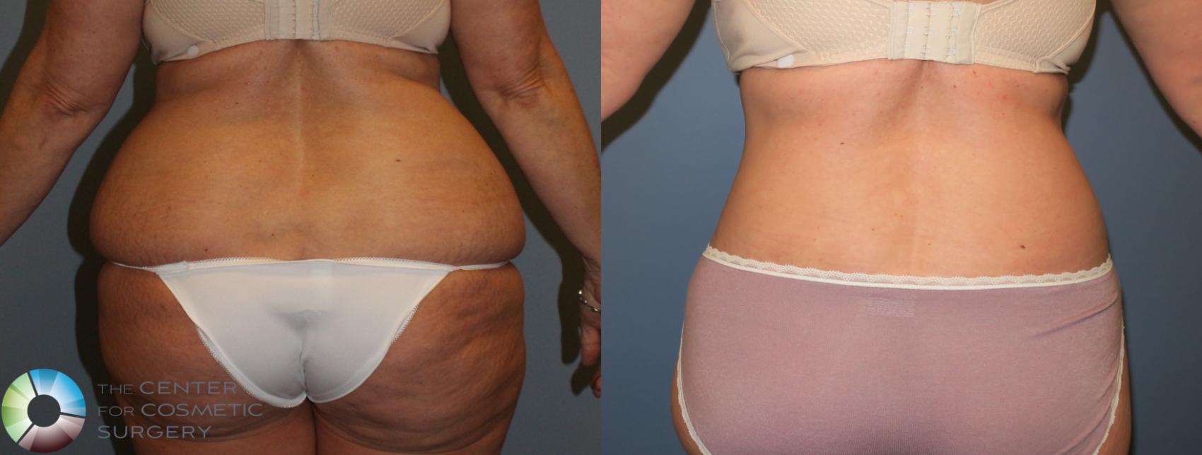Before & After Body Lift Case 765 View #2 View in Golden, CO