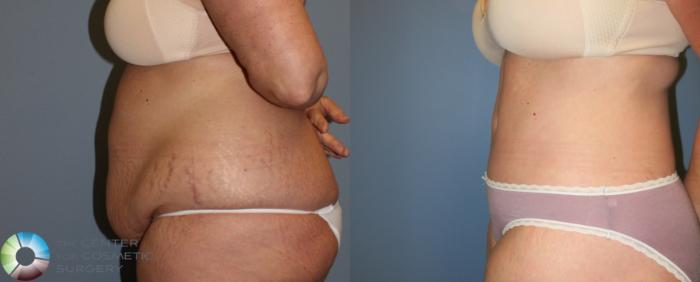 Before & After Body Lift Case 765 View #3 View in Golden, CO