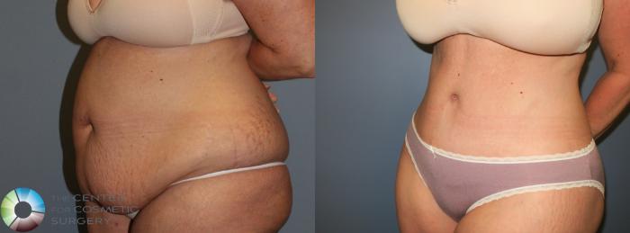 Before & After Body Lift Case 765 View #4 View in Golden, CO