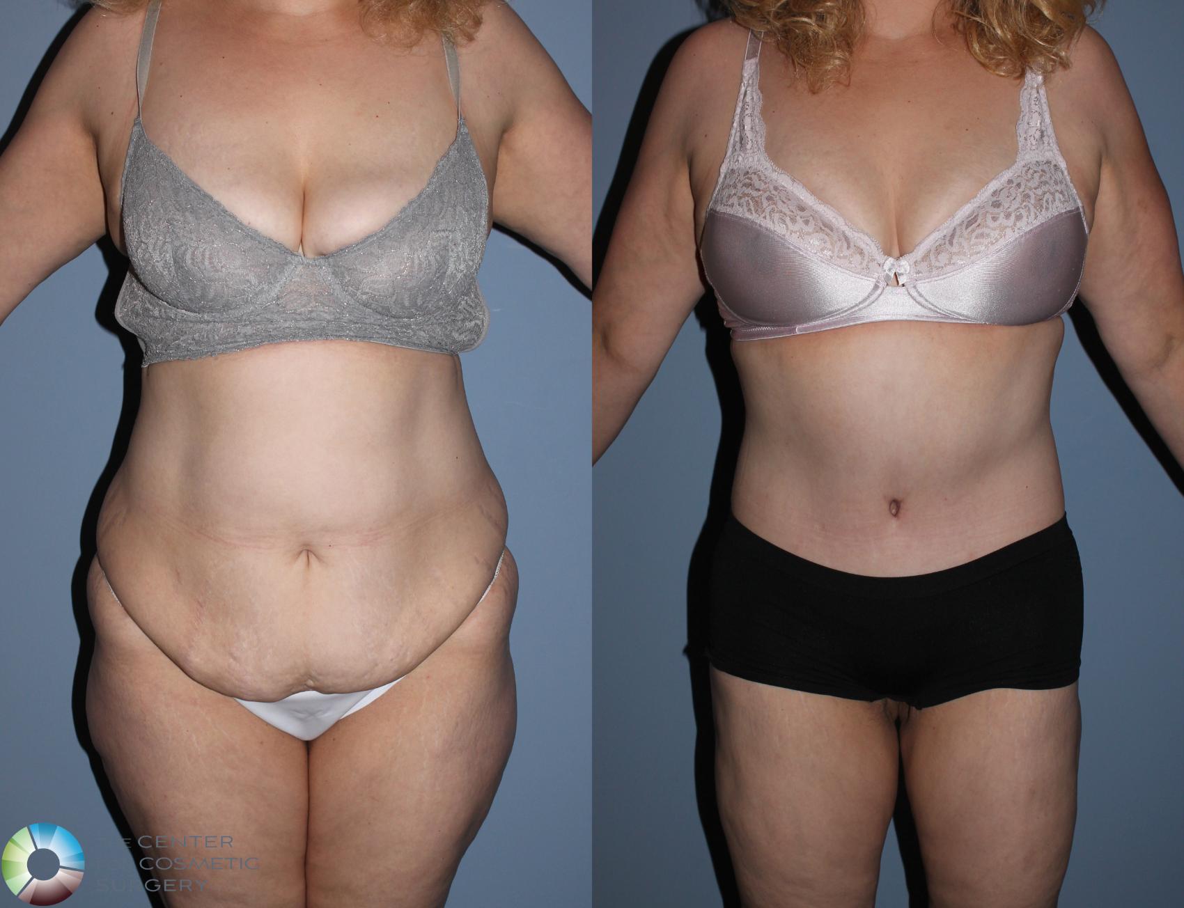 Before & After Buttock Lift Case 785 View #1 in Denver and Colorado Springs, CO