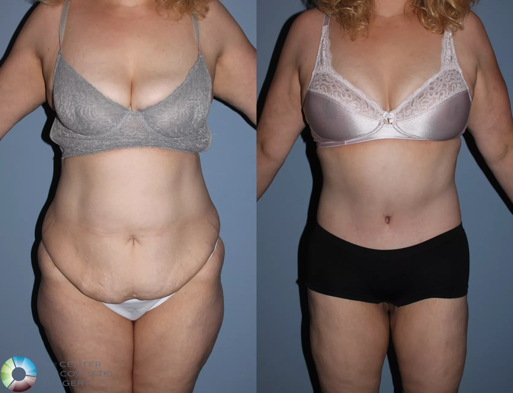 Back Lift (Upper Body Lift) Before and After Pictures Case 11677, Golden,  CO