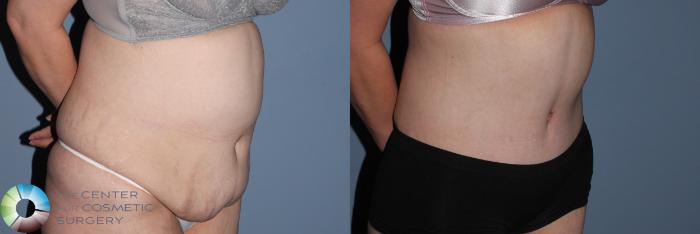 Before & After Tummy Tuck Case 785 View #3 View in Golden, CO