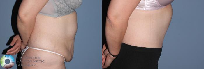 Before & After Tummy Tuck Case 785 View #4 View in Golden, CO