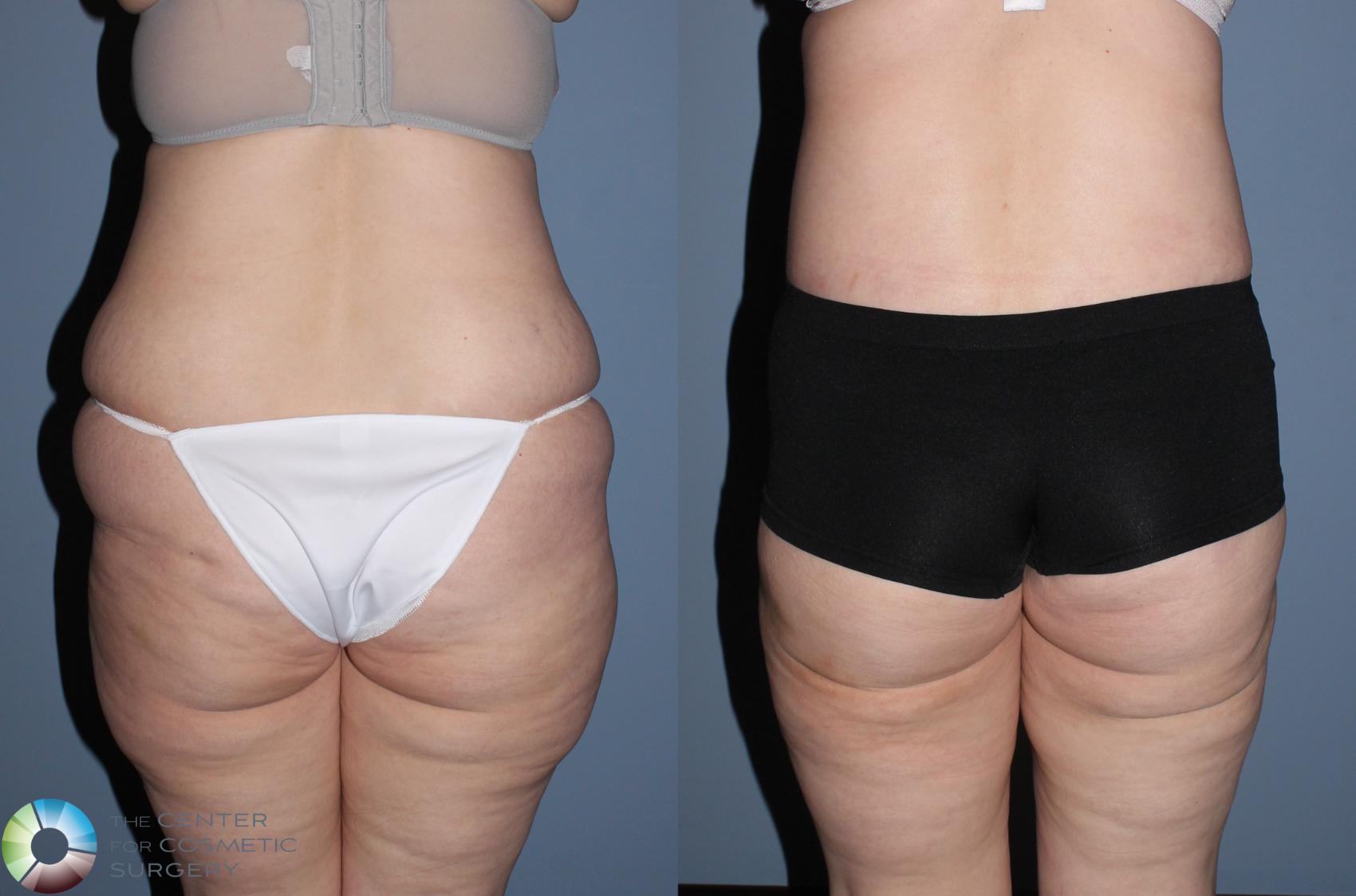 Before & After Body Lift Case 785 View #6 View in Denver & Golden, CO