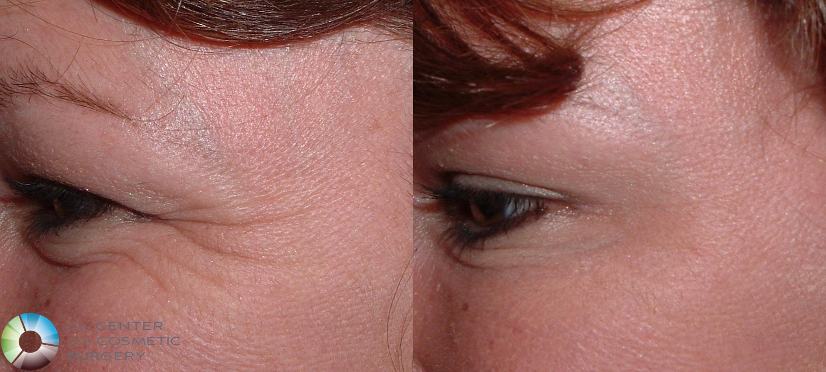 Before & After BOTOX® Cosmetic Case 158 View #1 View in Denver & Golden, CO