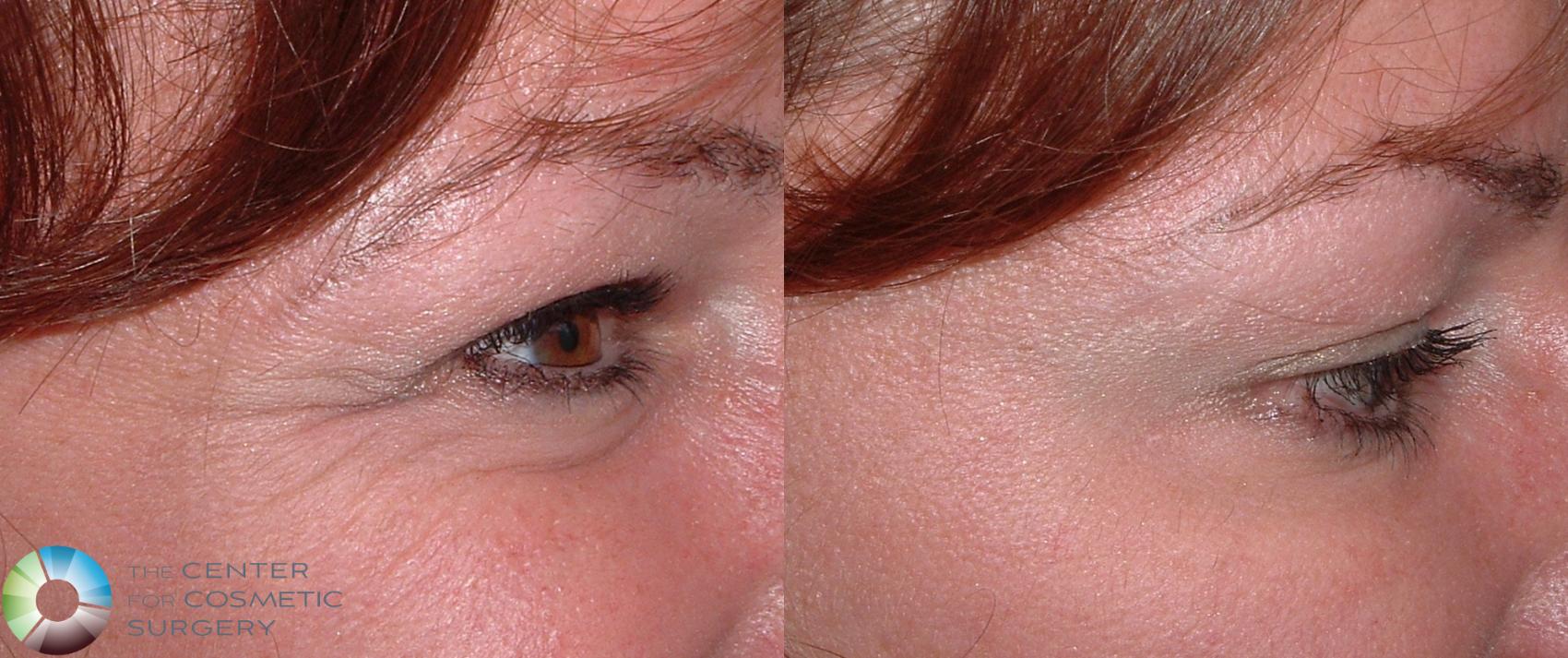 Before & After BOTOX® Cosmetic Case 158 View #2 View in Denver & Golden, CO