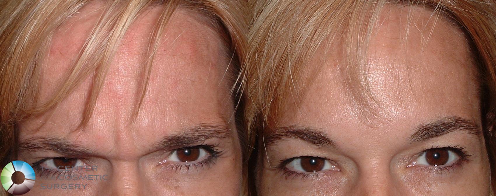 Before & After BOTOX® Cosmetic Case 159 View #1 View in Denver & Golden, CO