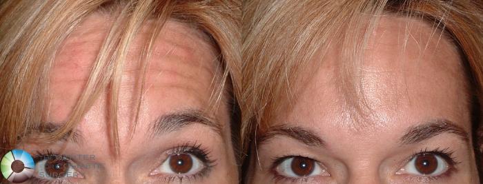 Before & After BOTOX® Cosmetic Case 159 View #2 View in Golden, CO