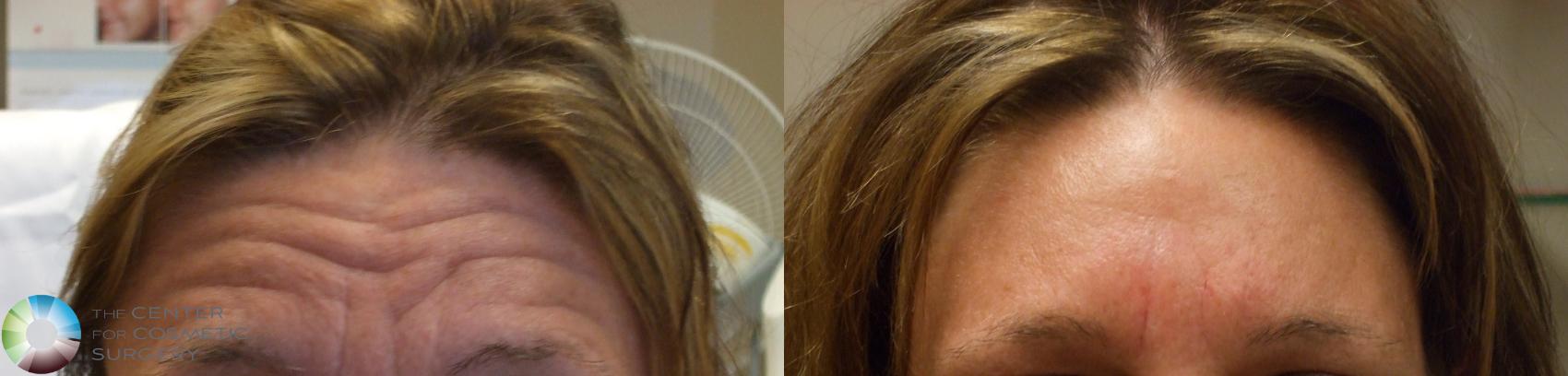 Before & After BOTOX® Cosmetic Case 278 View #1 in Denver and Colorado Springs, CO