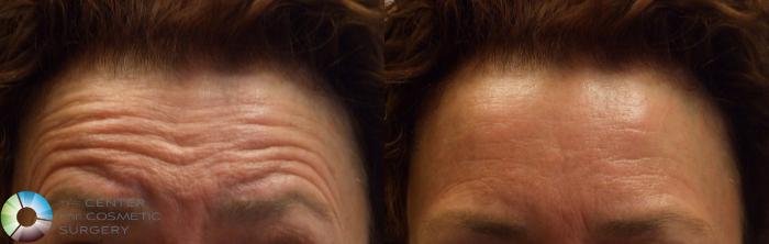 Before & After BOTOX® Cosmetic Case 279 View #1 View in Golden, CO