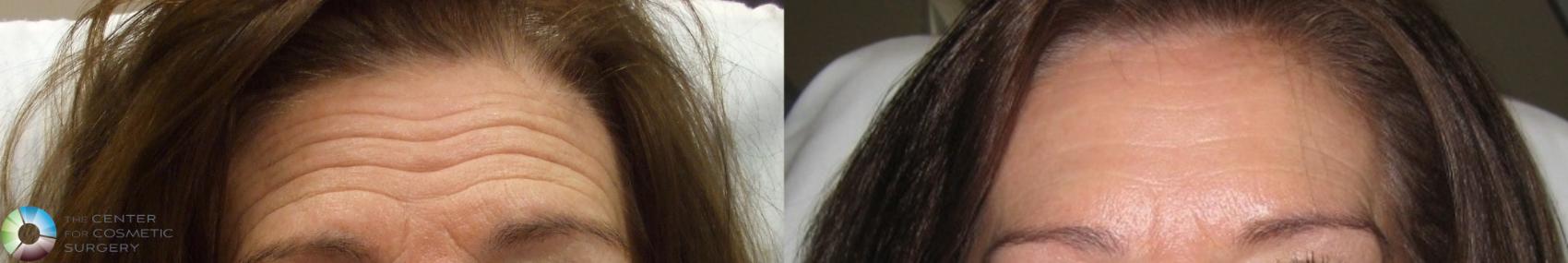 Before & After BOTOX® Cosmetic Case 280 View #1 View in Denver & Golden, CO