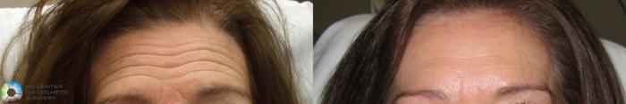 Before & After BOTOX® Cosmetic Case 280 View #1 View in Golden, CO