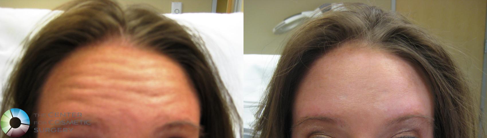 Before & After BOTOX® Cosmetic Case 281 View #1 in Denver and Colorado Springs, CO