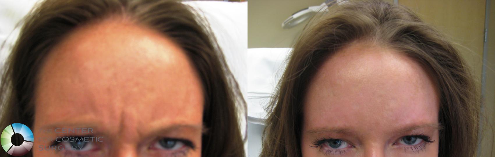 Before & After BOTOX® Cosmetic Case 281 View #2 View in Denver & Golden, CO