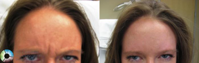 Before & After BOTOX® Cosmetic Case 281 View #2 View in Golden, CO