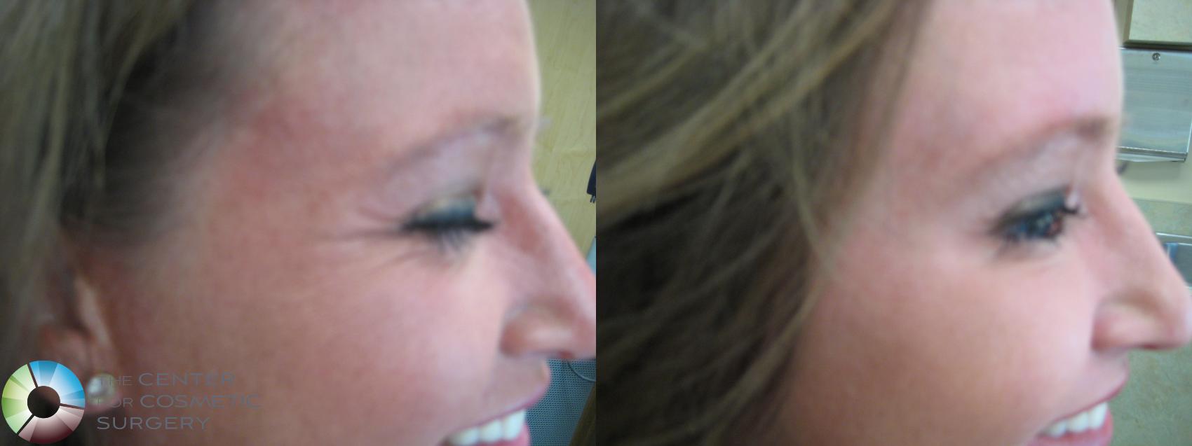 Before & After BOTOX® Cosmetic Case 281 View #3 View in Denver & Golden, CO