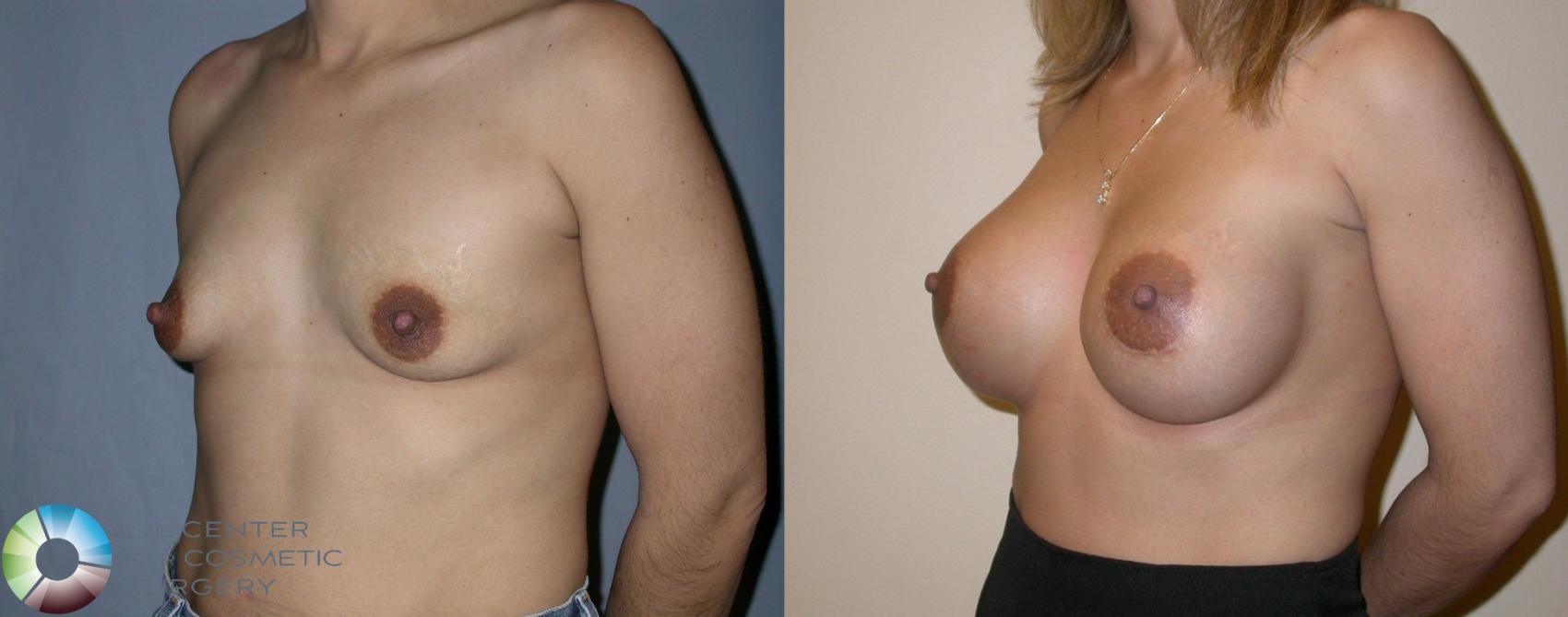 Before & After Breast Augmentation Case 1 View #1 in Denver and Colorado Springs, CO