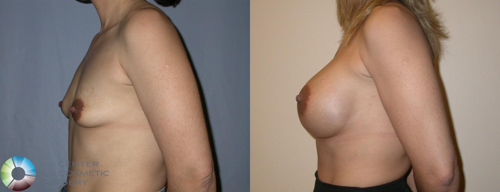 Before & After Breast Augmentation Case 1 View #2 View in Golden, CO
