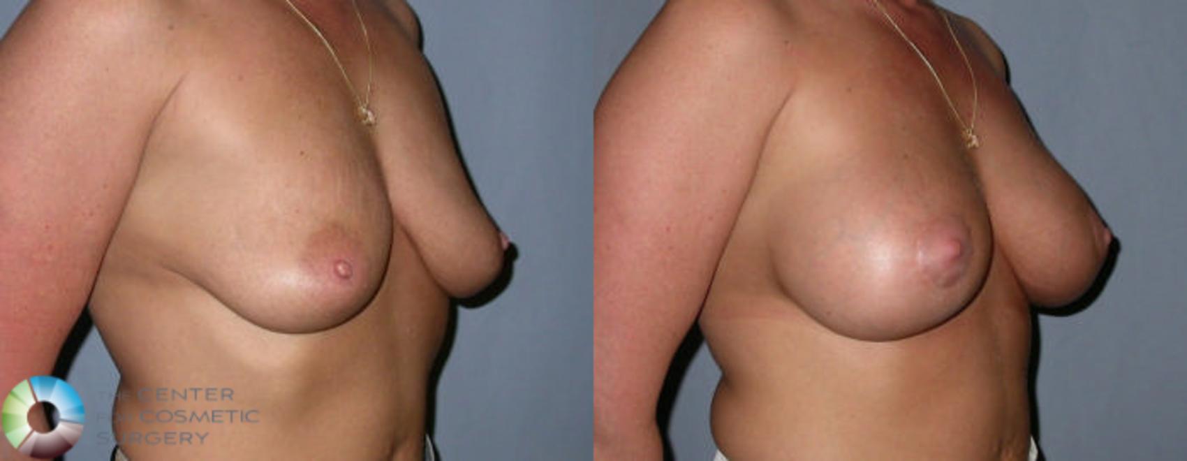 Before & After Breast Augmentation Case 10 View #1 in Denver and Colorado Springs, CO