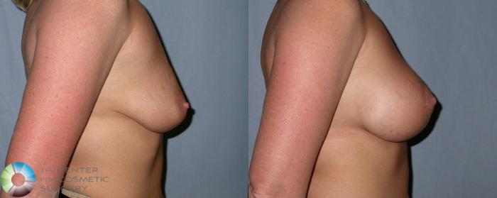 Before & After Breast Augmentation Case 10 View #3 View in Golden, CO