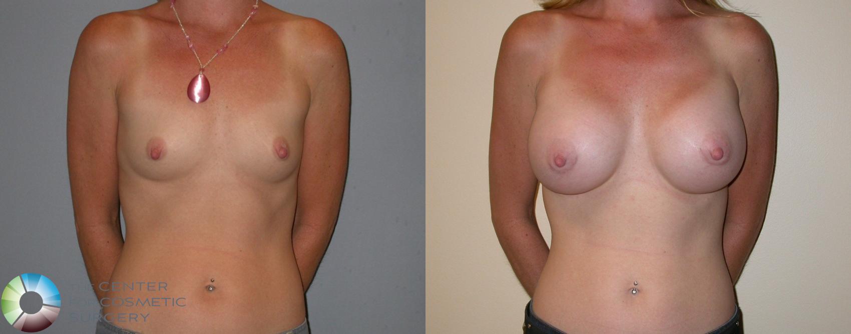 Before & After Breast Augmentation Case 100 View #1 View in Golden, CO