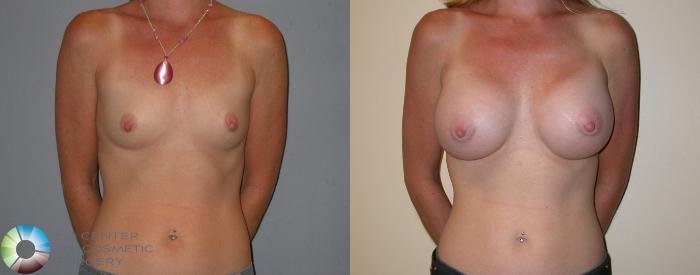 Before & After Breast Augmentation Case 100 View #1 in Denver and Colorado Springs, CO