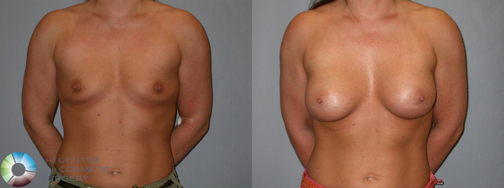 Before & After Breast Augmentation Case 101 View #1 View in Golden, CO