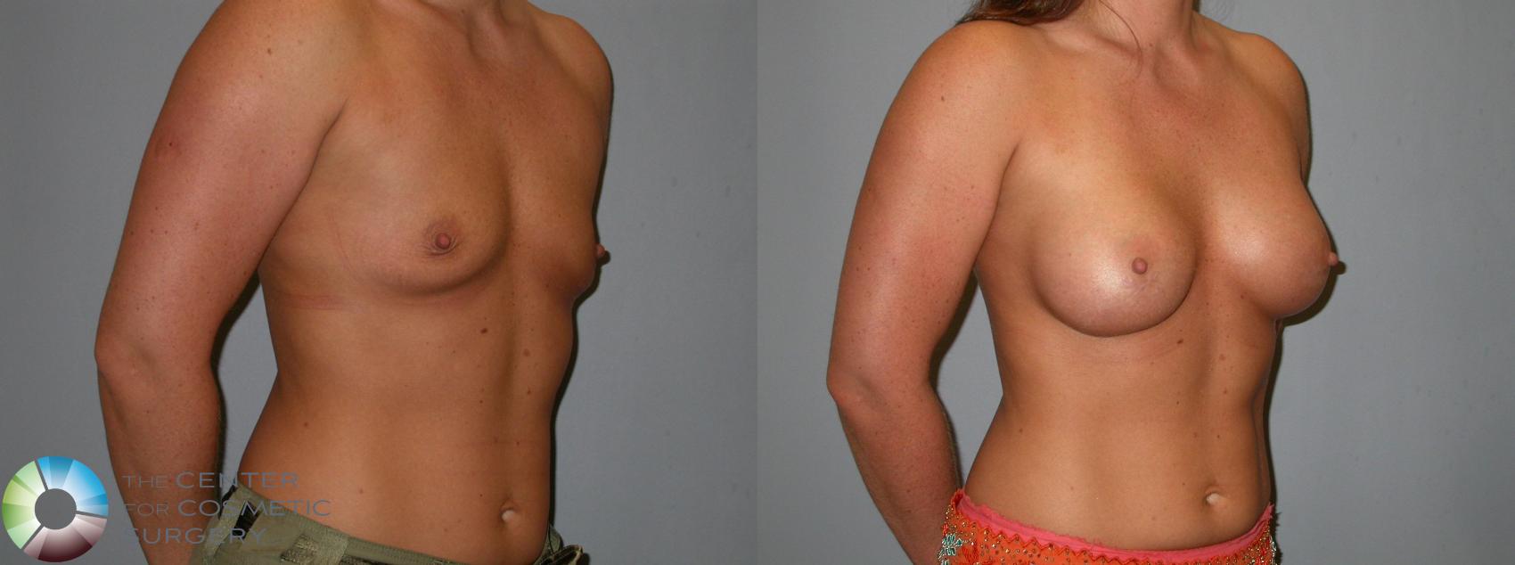Before & After Breast Augmentation Case 101 View #2 View in Golden, CO