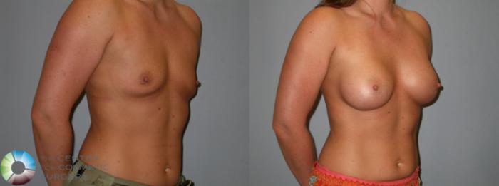 Before & After Breast Augmentation Case 101 View #2 in Denver and Colorado Springs, CO