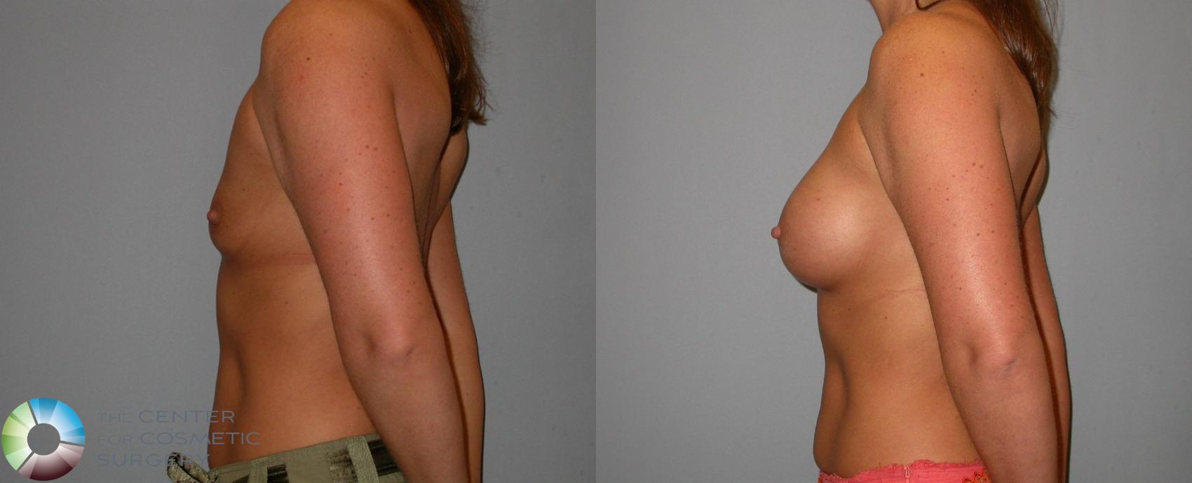 Before & After Breast Augmentation Case 101 View #3 View in Golden, CO